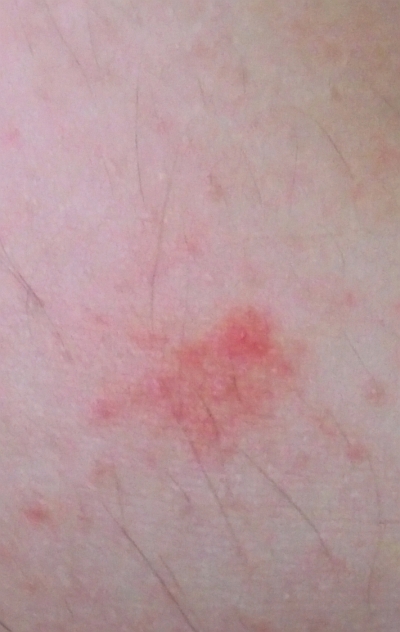 vörös foltok a bőrön sötét bordó melyik bőrbetegségek
